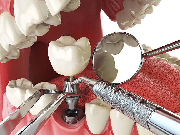 Best Emergency Root Canal Treatment in Sylvania, OH